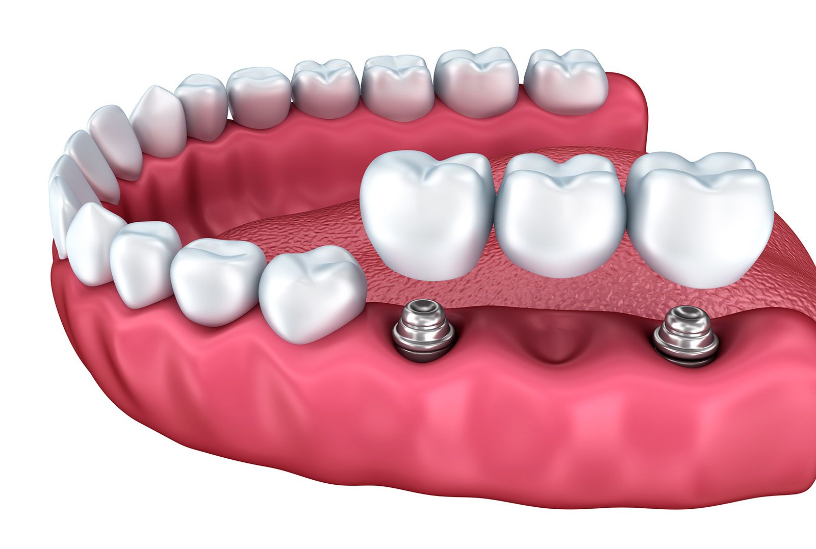Dental bridges and implants