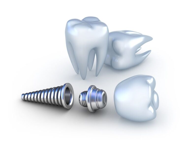 Understanding the Anatomy of a Dental Implant